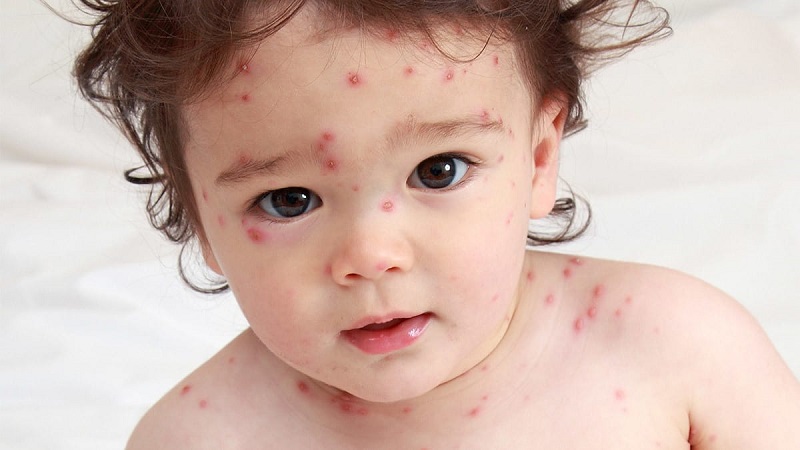 Nguyên nhân triệu chứng và cách điều trị thủy đậu