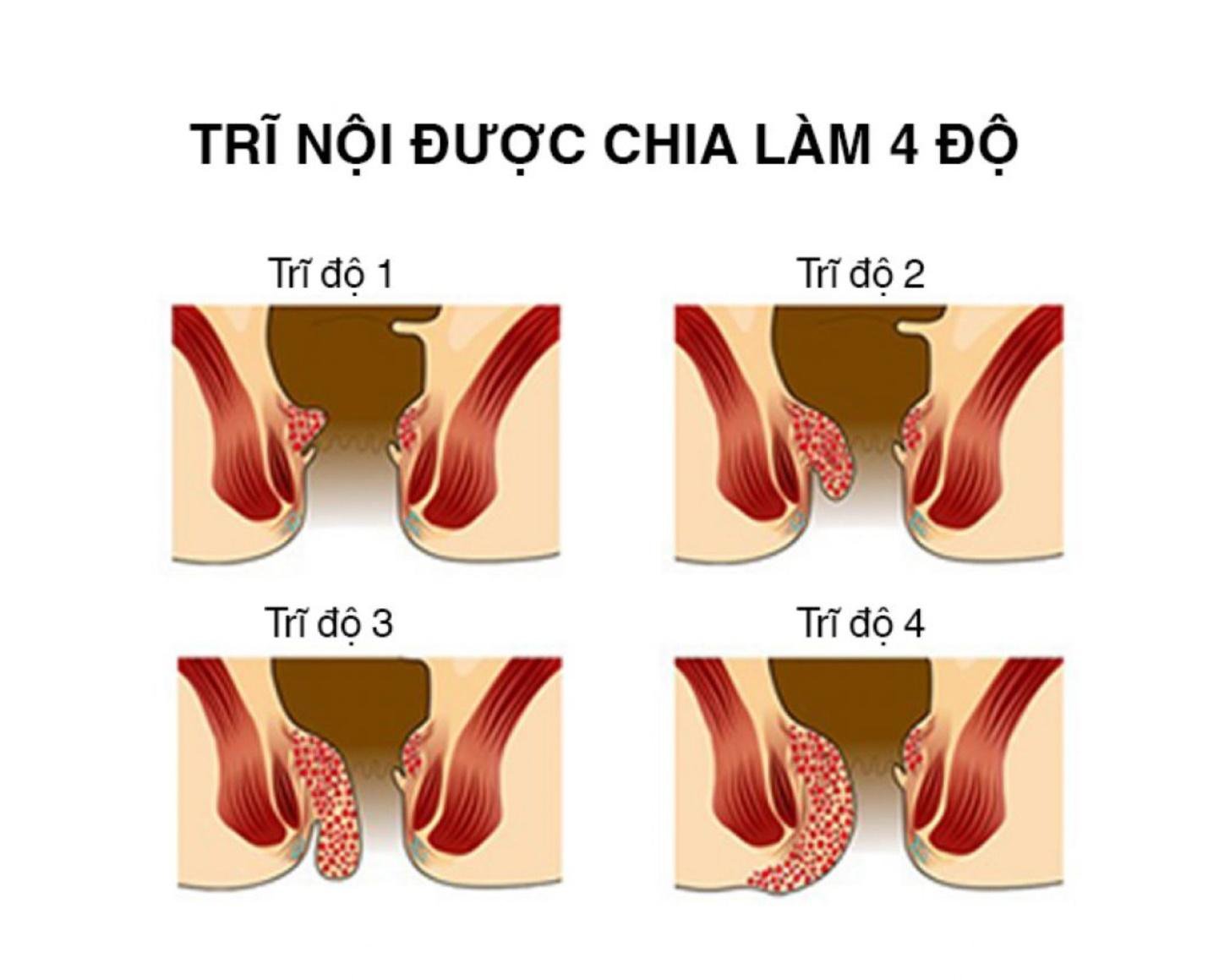 Bệnh trĩ từ A đến Z: Nguyên nhân, dấu hiệu và cách điều trị hiệu quả