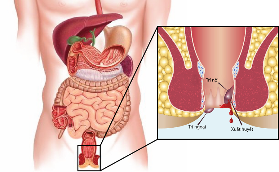 Cách phòng tránh bệnh trĩ