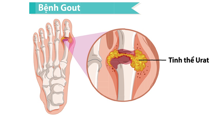 GỢI Ý 4 CÁCH PHÒNG NGỪA BỆNH GOUT ĐƠN GIẢN, HIỆU QUẢ TẠI NHÀ