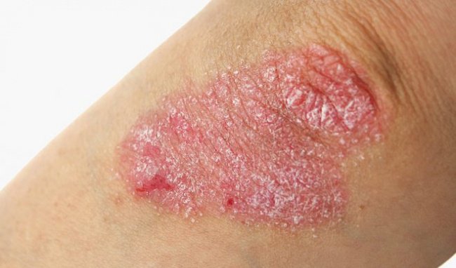 Các nguyên nhân gây bệnh vảy nến