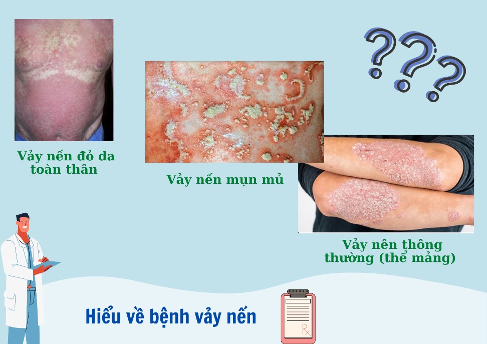 Hiểu về bệnh vảy nến