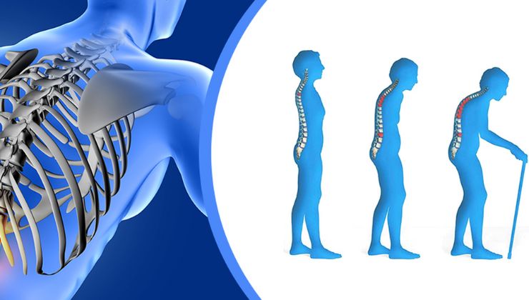 Loãng xương, hiểu thế nào cho đúng?