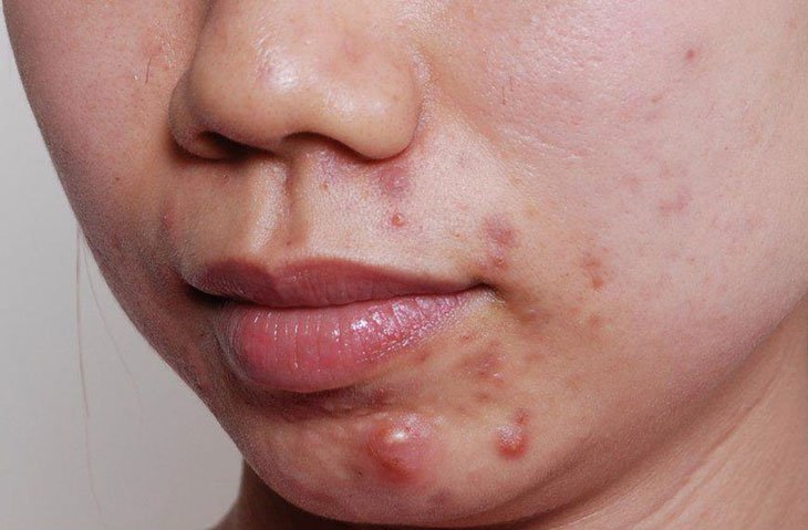 CÁC CHẤT BỔ SUNG HỖ TRỢ ĐIỀU TRỊ MỤN TRỨNG CÁ